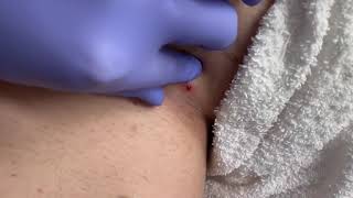 Bikini Line Ingrown Hair Removal