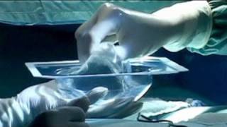 Los implantes mamarios de PIP, problema mundial