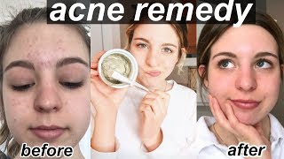 How to Get Rid of Acne | Teen Skin Care Routine