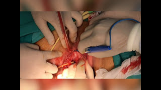 Basit vulvektomi  (Simple vulvectomy)