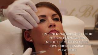 Lippenunterspritzung mit Hyaluronsäure