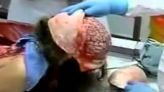 Real Woman Autopsy *WARNING: GRAPHIC CONTENT* Medical Education