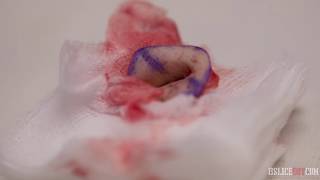 Belly Button Removal (Nullification)