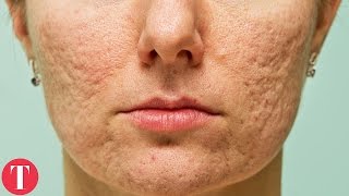 10 Things You Didn't Know About ACNE