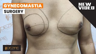 Gynecomastia ! Man Boobs Surgery ( No scar &  No Side Effects ) By Dr. Prashant Yadav