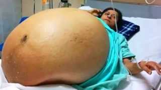 Giant Cyst or Pregnant?