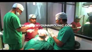 Facial Hair Transplant in India