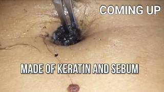 Navel Stone or Giant Belly Blackhead?  Bizarre Medical