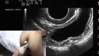 Prostata per via transrettale