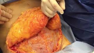 Tummy tuck