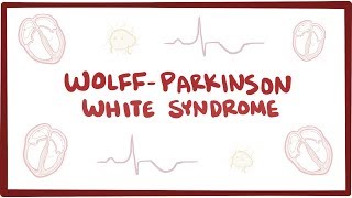 Wolff-Parkinson-White syndrome (WPW) - an Osmosis Preview