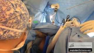 Vaginal Vault Suturing