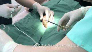 睾丸摘出手術　orchidectomy