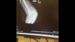 BROKEN ARMED BOY!