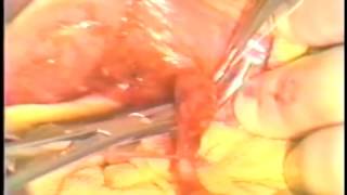 COLECISTECTOMIA Y COLEDOCODUODENO ANASTOMOSIS x LITIASIS BILIAR - 220
