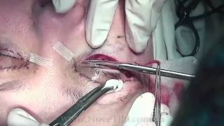 Впечатлительным не смотреть! | Блефаропластика в 3 х минутах | Eyelid plastic surgery in 3 minutes