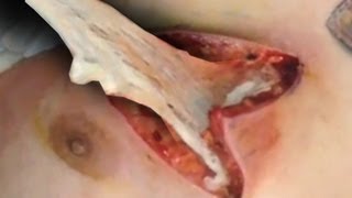 *Warning Graphic Content* MRSA Open Wound