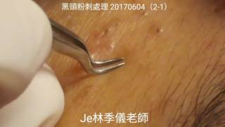 20170604黑頭粉刺處理2-1