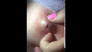 Popping a big abscess!!!!