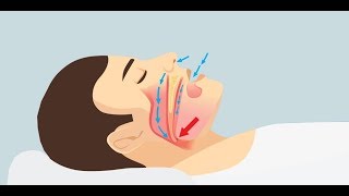 Почему мы храпим и как перестать