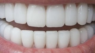 HOW TO HAVE NATURAL WHITE TEETH IN 3 MINUTES ( WORKS 100% )