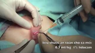 INGUINAL ORCHIDOPEXY