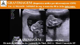 GRAVIMAGEM 21486 Ultrassom morfológico em gravidez 22 semanas mp1