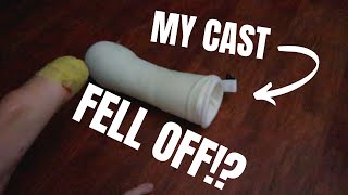 My Amputee Leg Cast FELL OFF 9 Days After Surgery!?