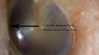 514  - Complex Ear Wax Removal off Eardrum and Anterior Recess of Ear Canal