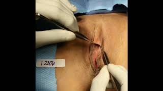 Revision Labiaplasty