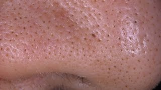 Выдавливание черных точек, угрей на носу/Nose Blackheads Squeezing