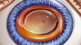 ИОЛ (интраокулярные линзы) для имплантации при катаракте - как выбрать