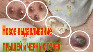 Новое выдавливание ПРЫЩЕЙ и ЧЕРНЫХ ТОЧЕК! Blackheads- Acne(Part 105)