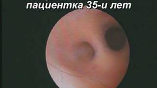 Чистка после выкидыша осложнилась спайкой. Лечение.