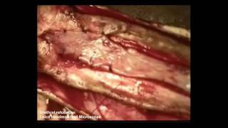 Leica HM500 User Video Surgery - Urethral relocation