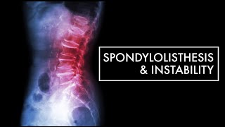 Treatment of Spondylolisthesis & Instability | Dr. Douglas Won | Top10MD