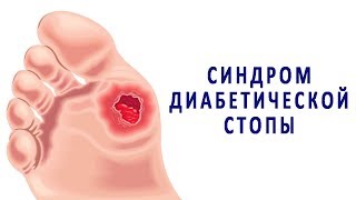 Симптомы и лечение диабетической стопы. Профилактика гангрены при сахарном диабете