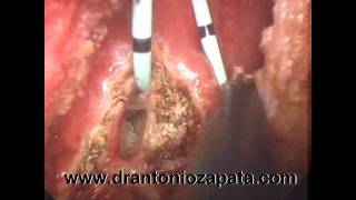 fistula vesicovaginal tratamiento laparoscopico