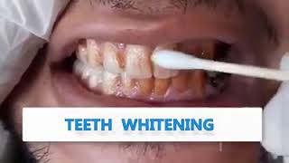 মাত্র ১৫ সেকেন্ডের  মধ্যে দাত করে তুলুন  ঝকঝকে পরিস্কার ??