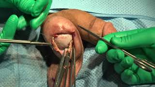 Hydrocelectomy using a minimally invasive, office-based approach