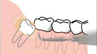 L'extraction de dents de sagesse dans le film d'animation