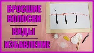 Вросший волос. Виды. Как избавиться