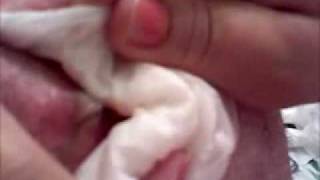my mom popped a cyst on my back part 1
