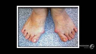 припухла косточка на ноге

  - рекомендую лечение hallux valgus косточки