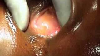 Cryptomenorrhoea Hidden Menstruation- www.procedures.tk