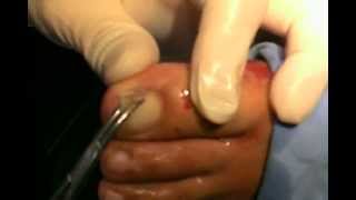 Ingrown toenail treatment apparatus K-D 3. 발톱의 넓이가 일반 사이즈