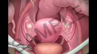 How to operate Total abdominal hysterectomy step by step