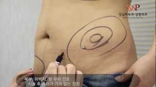 의료진 인터뷰 지방흡입