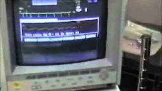 Central Venous Pressure CVP monitoring Tutorial