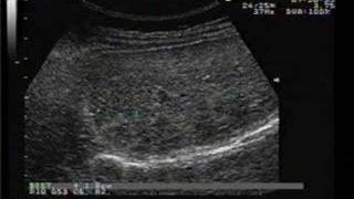 Hemangioma